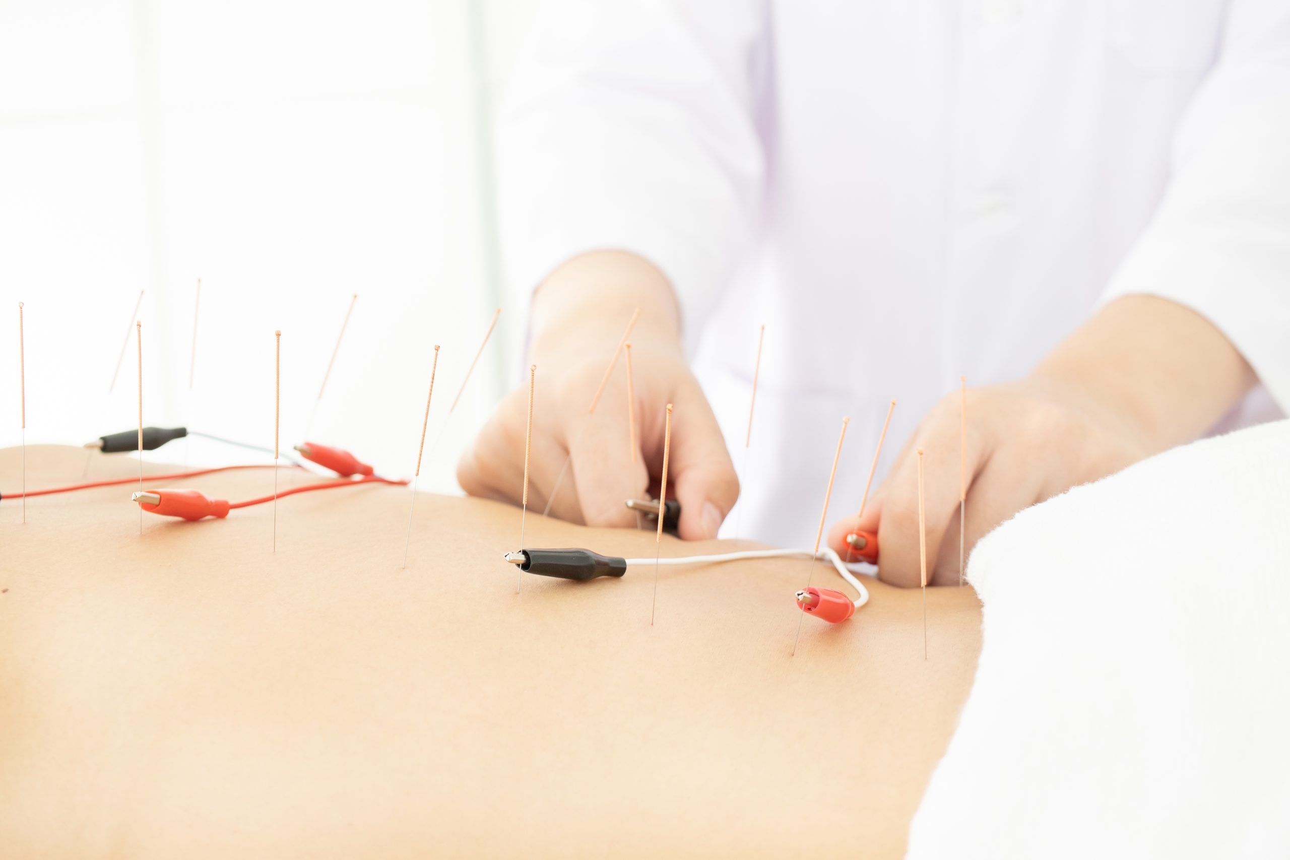 Electrical Stimulation of Acupuncture Needles