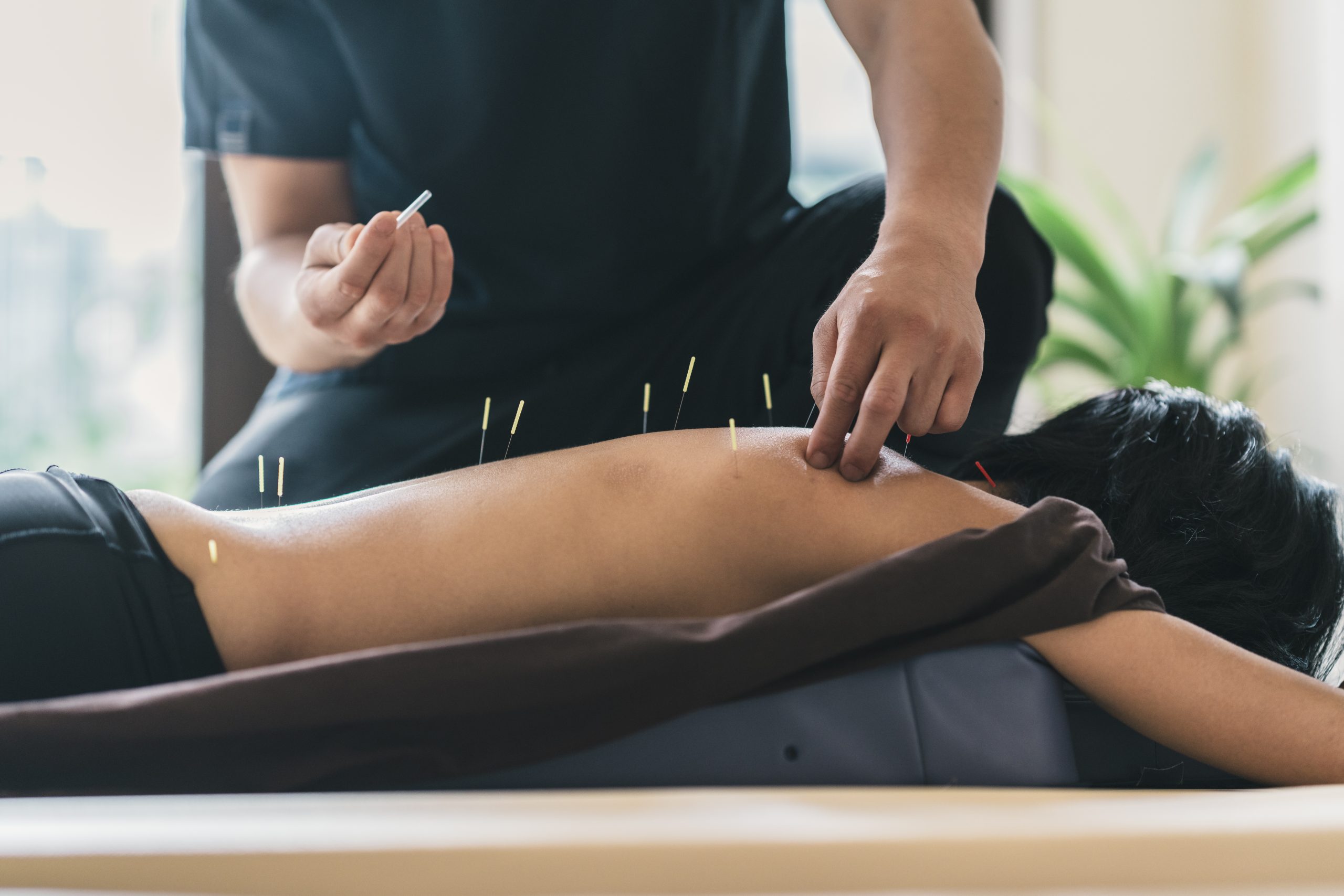 Therapist giving an acupuncture treatment to a patient on a table