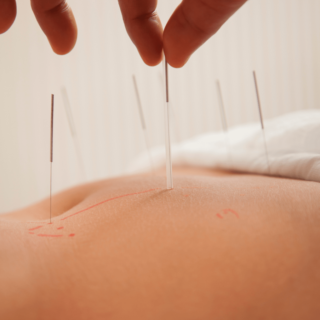 Relaxing Acupuncture Treatment On Stomach